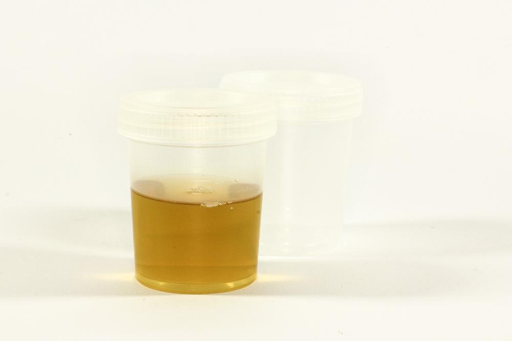 urine analysis