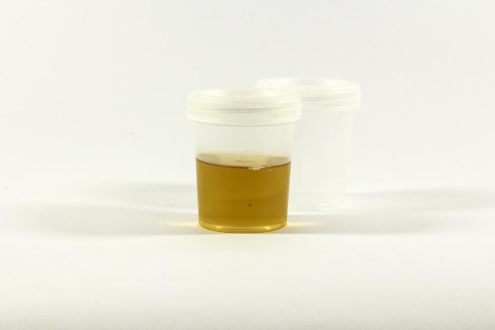 urine analysis